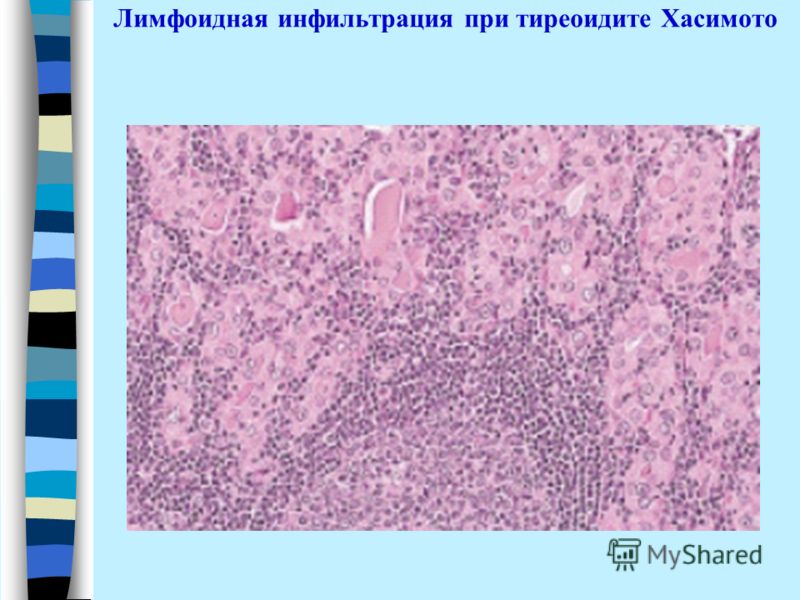 Инфильтрация это. Лимфоидноклеточная инфильтрация. Лимфоидная инфильтрация гистология. Лимфоидная инфильтрация стромы что это. Диффузно-очаговая лимфоидная инфильтрация.