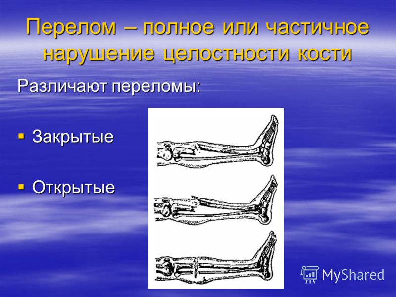 Перелом костей человека. Переломы костей закрытый открытый.