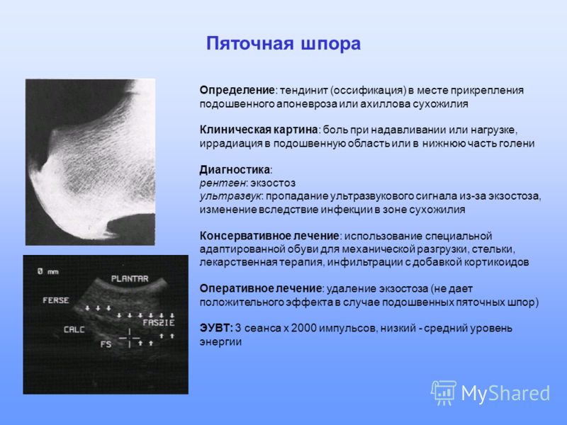 Пяточные и ахилловы шпоры. УЗИ ахиллова сухожилия заключение. Пяточная шпора рентген описание. Рентген признаки пяточной шпоры.