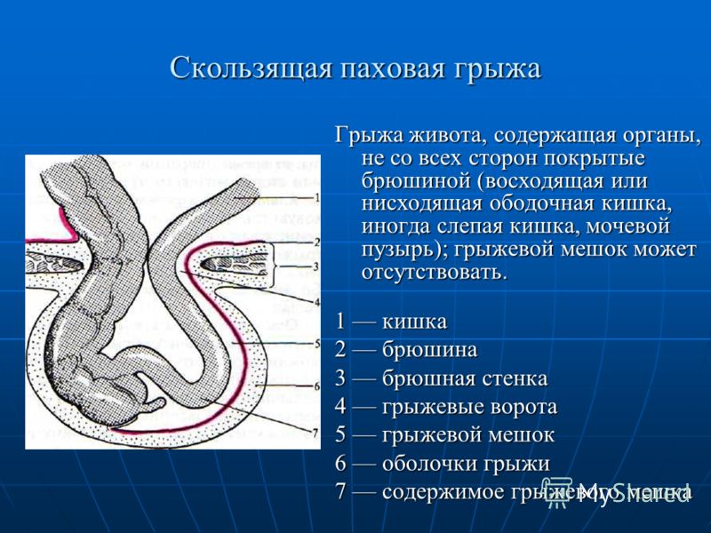 Паховая грыжа у мужчин где находится картинка причины симптомы и причины