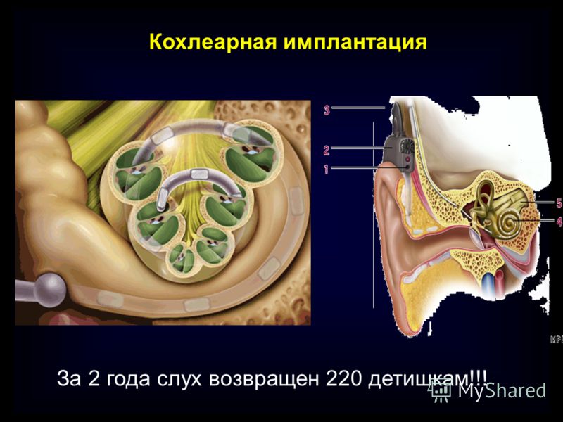 Кохлеарная имплантация презентация