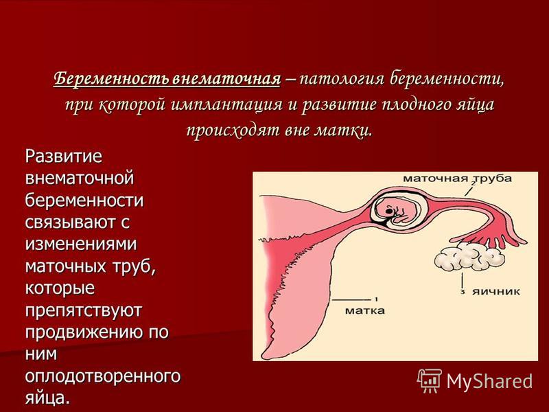 Беременность протекает. Разрыв маточной трубы внематочная беременность. Внематочная беременность Трубная ампулярную. Места локализации эктопической беременности. При ампулярной трубной беременности..