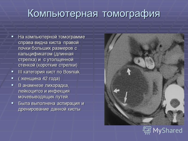 Типы кисты почек. Субкапсулярная киста почки кт. Солитарная киста почки кт. Паренхиматозные кисты почек кт. Кистозная нефрома почки кт.