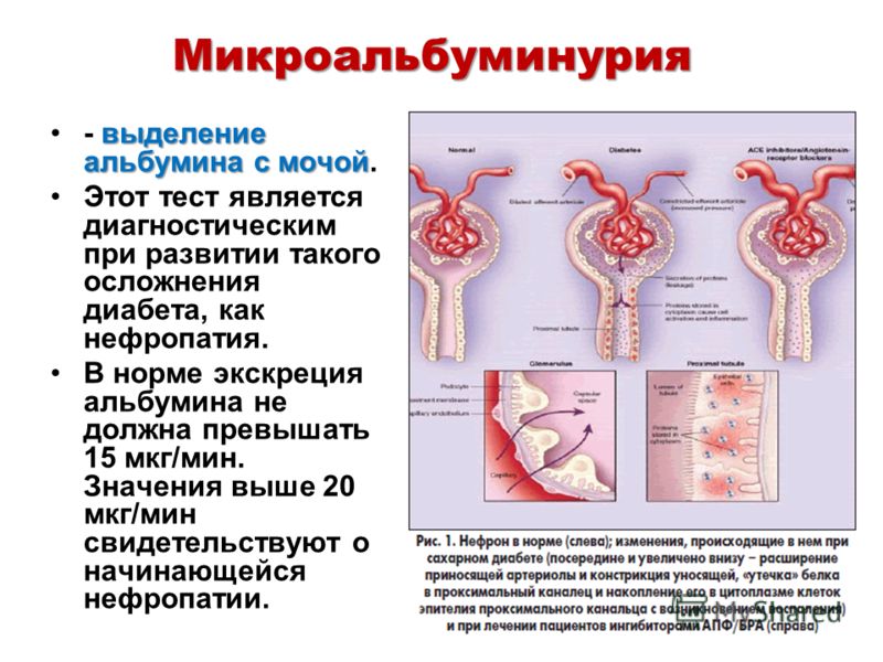 Сильное выделение мочи. Экскреция альбумина с мочой. Микроальбуминурия. Высокая экскреция альбумина. Повышение альбумина в моче.