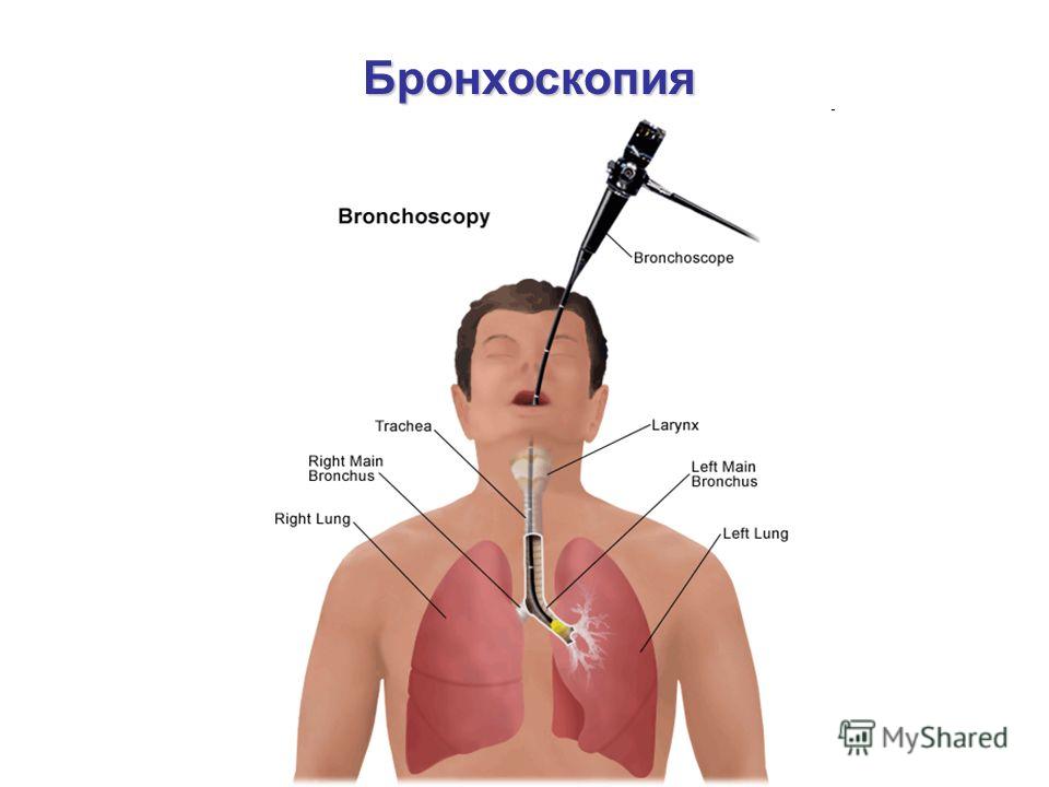 Лечение рака трахеи. Эндоскопическое исследование бронхов.