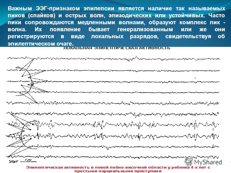 Ээг показывает эпилепсию. Миоклоническая эпилепсия ЭЭГ. ЭЭГ эпилепсия пик-волна. Региональная эпилептиформная активность ЭЭГ. ЭЭГ при юношеской миоклонической эпилепсии.