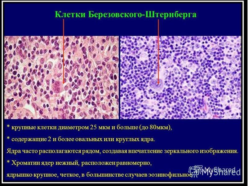 Болезнь ходжкина картина крови