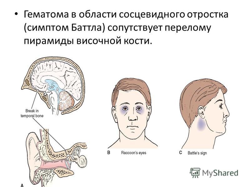 Синдром очков. Перелом основания черепа симптомы. Гематома височной области. Перелом основания черепа симптом очков. Перелом височной кости симптомы.