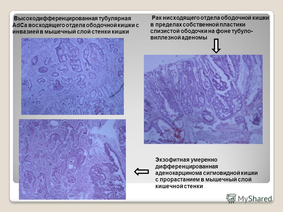 Тубулярно ворсинчатая аденома с интраэпителиальной неоплазией. Тубулярная аденокарцинома гистология. Ворсинчатая аденома толстой кишки микропрепарат. Аденома толстой кишки микропрепарат. Аденокарцинома желудка патологическая анатомия.