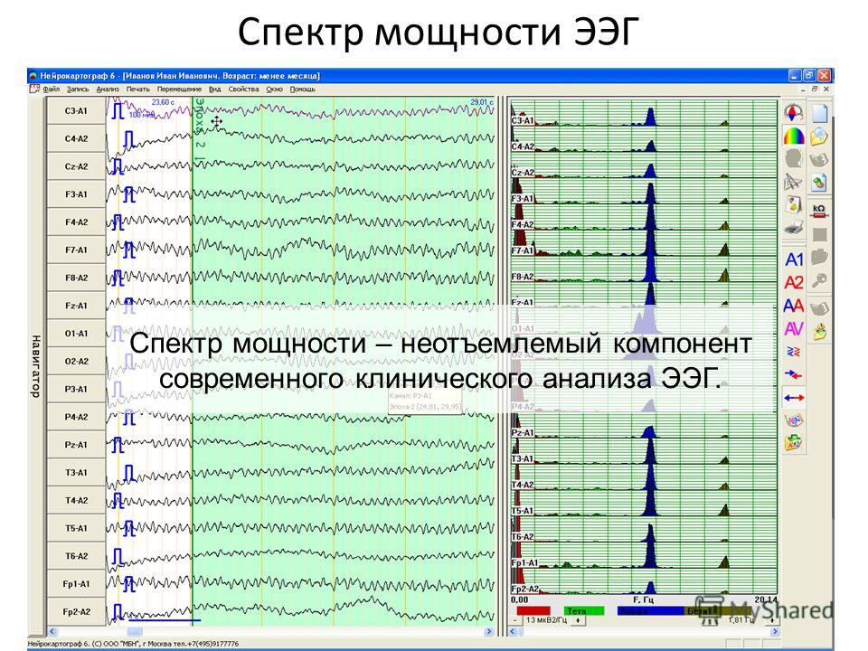 Описание ээг. Вертексные потенциалы на ЭЭГ. Спектры мощности ЭЭГ. ЭЭГ сигнал. Анализ электроэнцефалограммы.