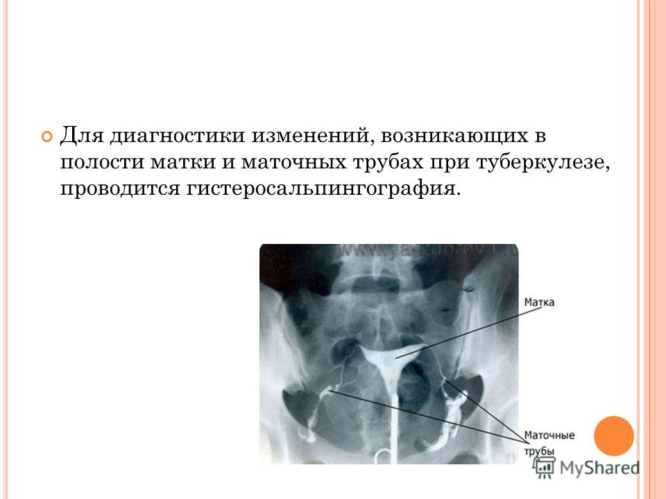 Непроходимость маточных труб. Гистеросальпингография туберкулез. Туберкулез маточных труб. Непроходимость маточных труб симптомы. Непроходимость труб симптомы.