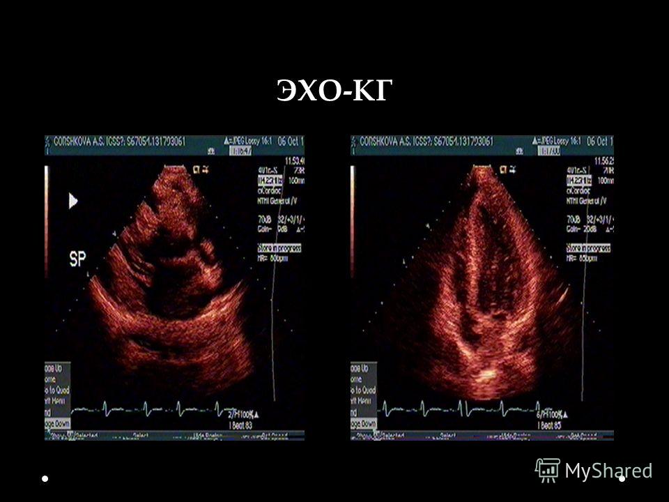 Эхокг. Эхо кг. PHT на ЭХОКГ. МЖП В эхокардиографии.