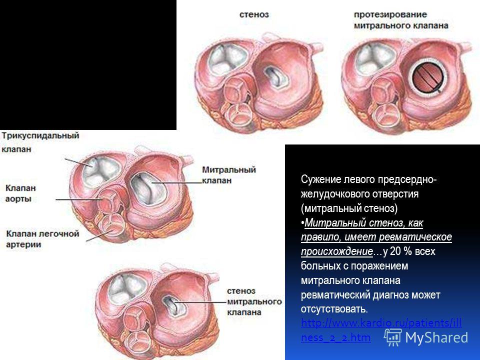 Стеноз митрального клапана презентация - 88 фото