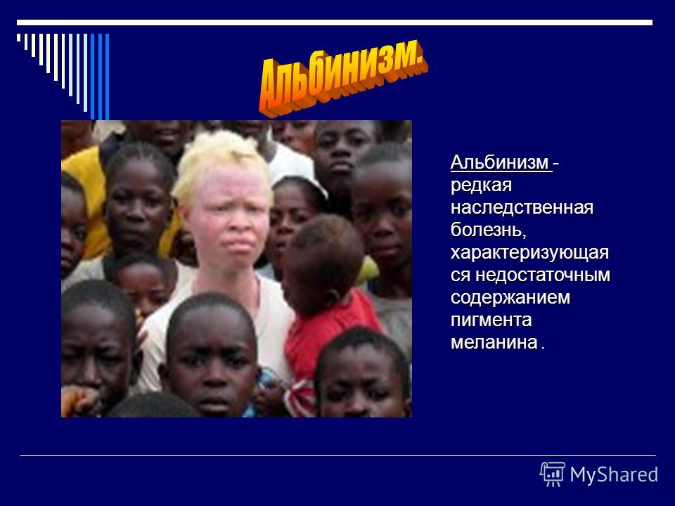 Альбинизмом страдают. Наследственная болезнь альбинизм. Альбинизм генная мутация. Альбинизм причины мутации. Генетические заболевания альбинизм.