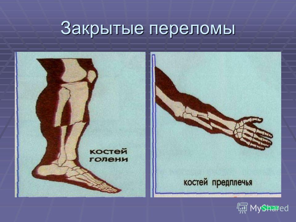 Закрытый перелом. Переломы костей презентация. Презентация на тему переломы.