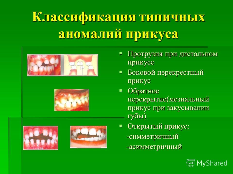 Мезиальный прикус презентация