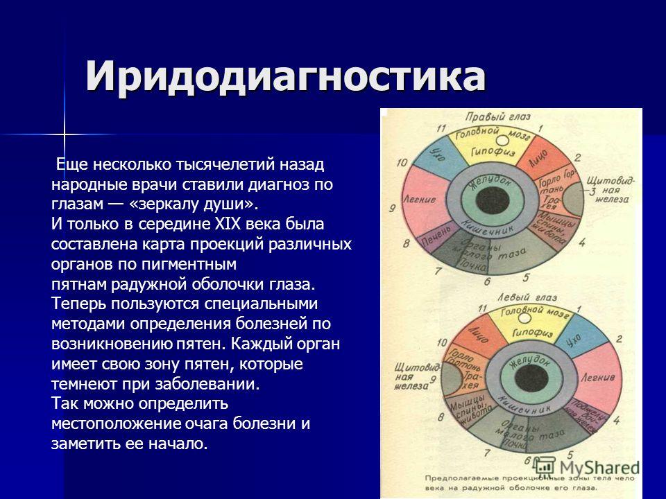 Иридодиагностика фото с расшифровкой