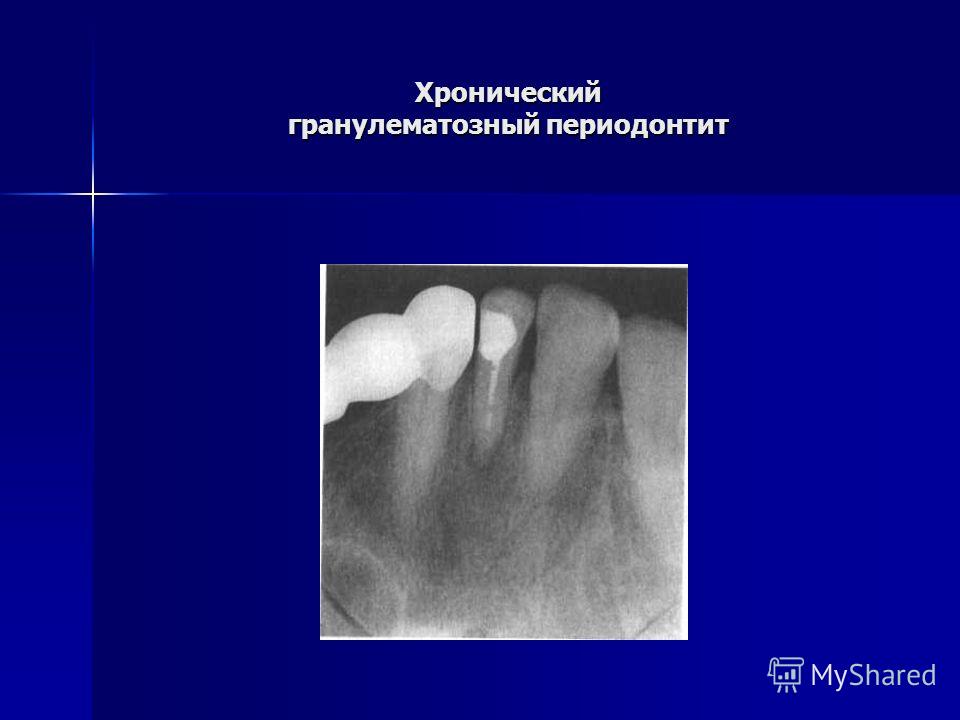 Хронический фиброзный периодонтит лечение