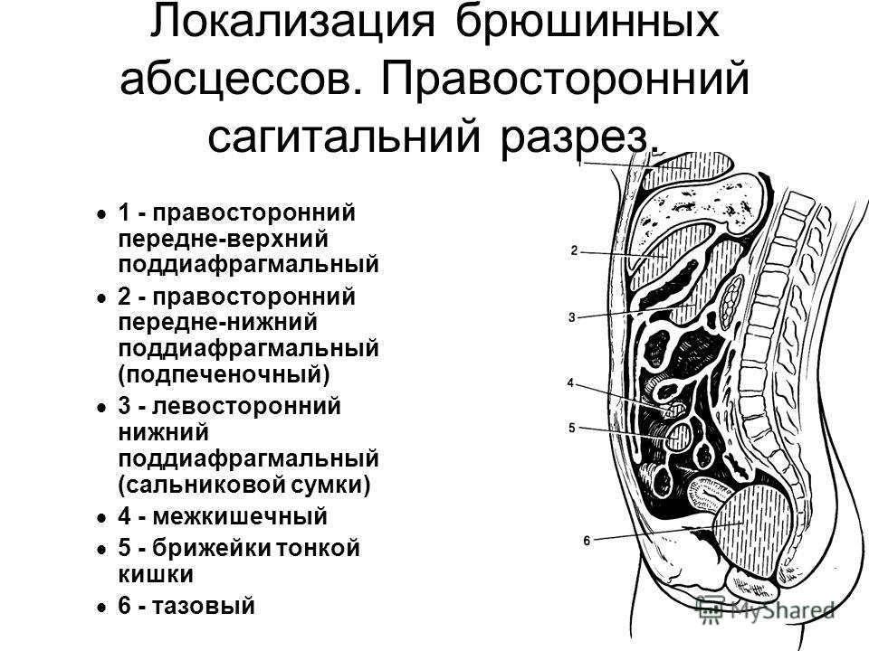 Пространства брюшной полости. Ход брюшины сальниковая сумка. Поддиафрагмальное пространство брюшины. Правосторонний поддиафрагмальный абсцесс. Локализация гнойников в брюшной полости.