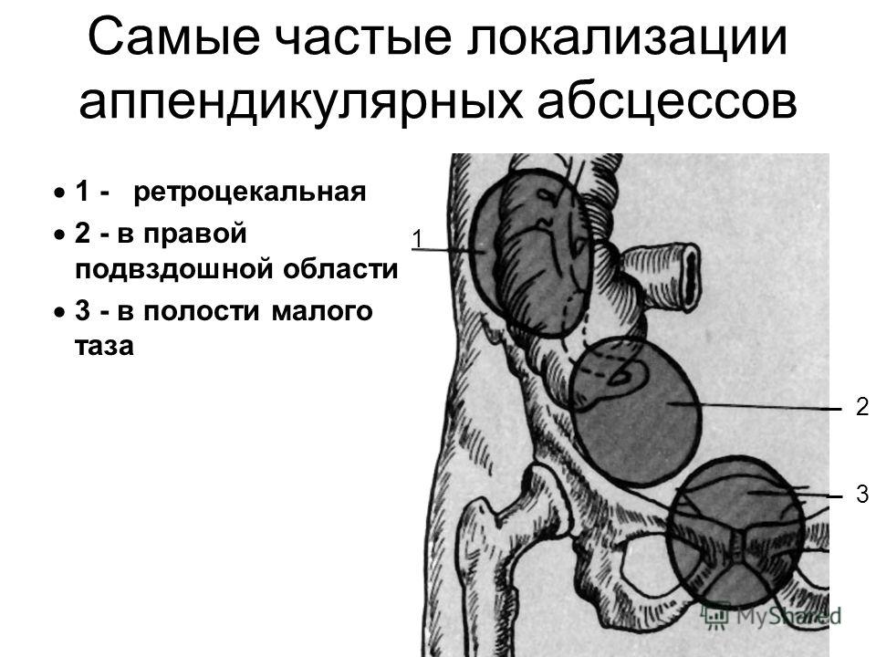 Абсцесс после аппендэктомии