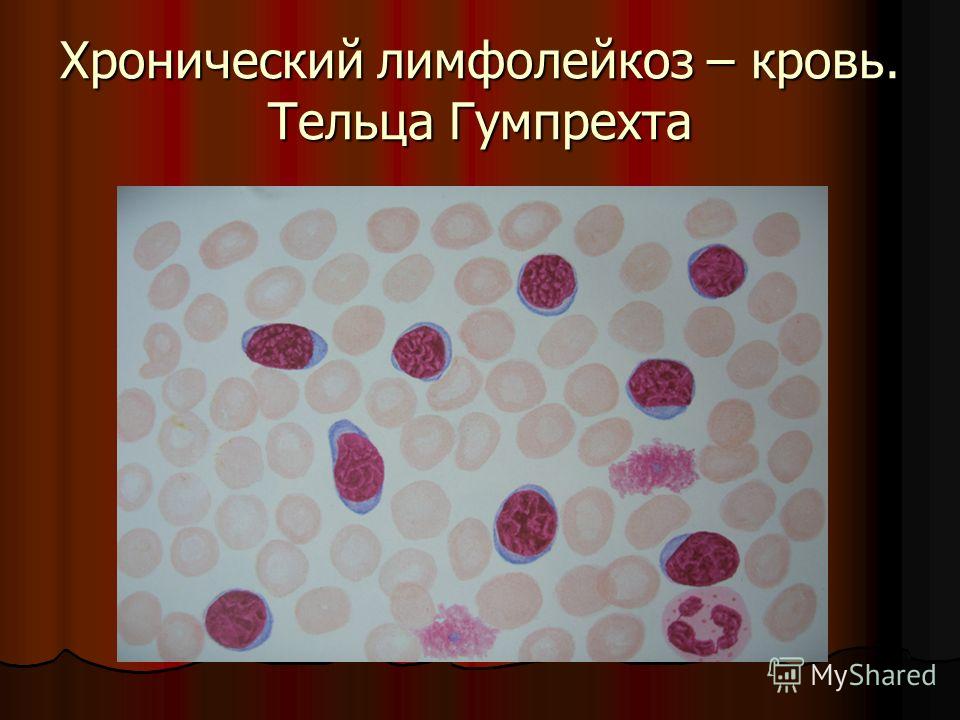 Тени Боткина Гумпрехта. Хронический лимфоцитарный лейкоз картина крови. Клетки Боткина Гумпрехта это. Кровь при лимфолейкозе
