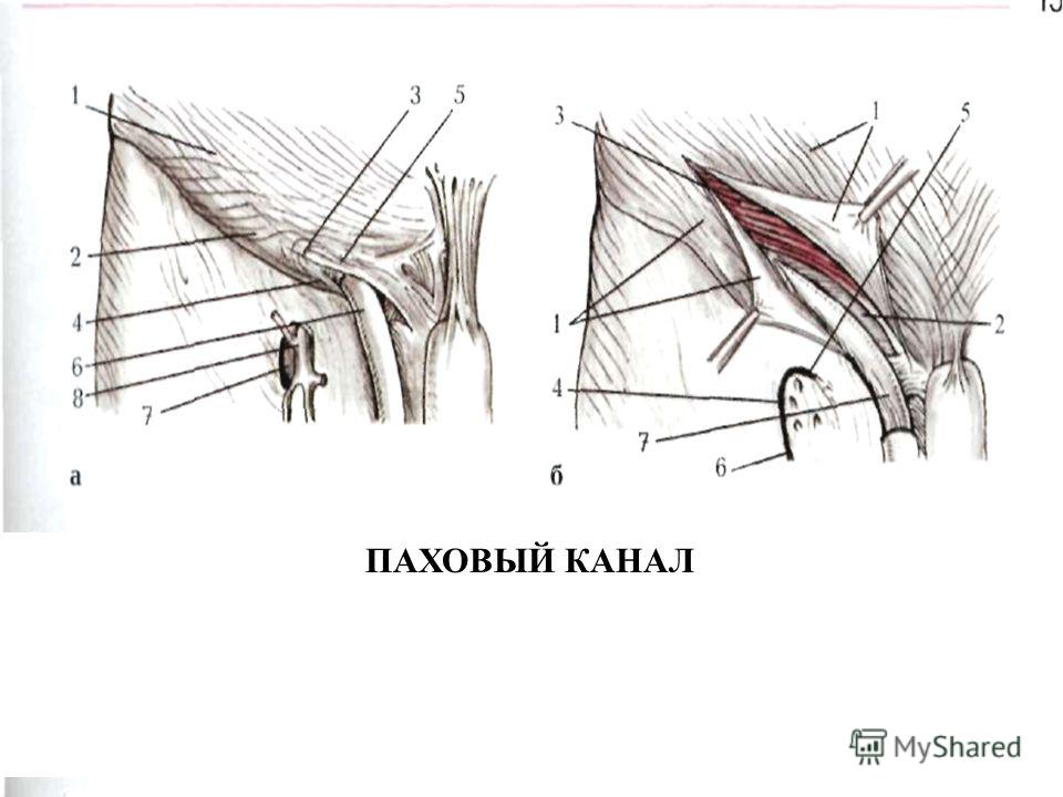 Где находится канал. Стенки пахового канала анатомия. Паховый канал топографическая анатомия. Паховый канал вид спереди. Паховый треугольник схема.