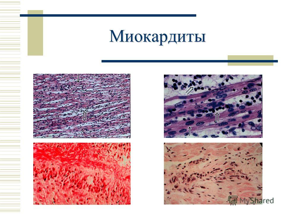 Миокардит симптомы. Апостематозный миокардит. Хронический активный миокардит. Подострый миокардит.