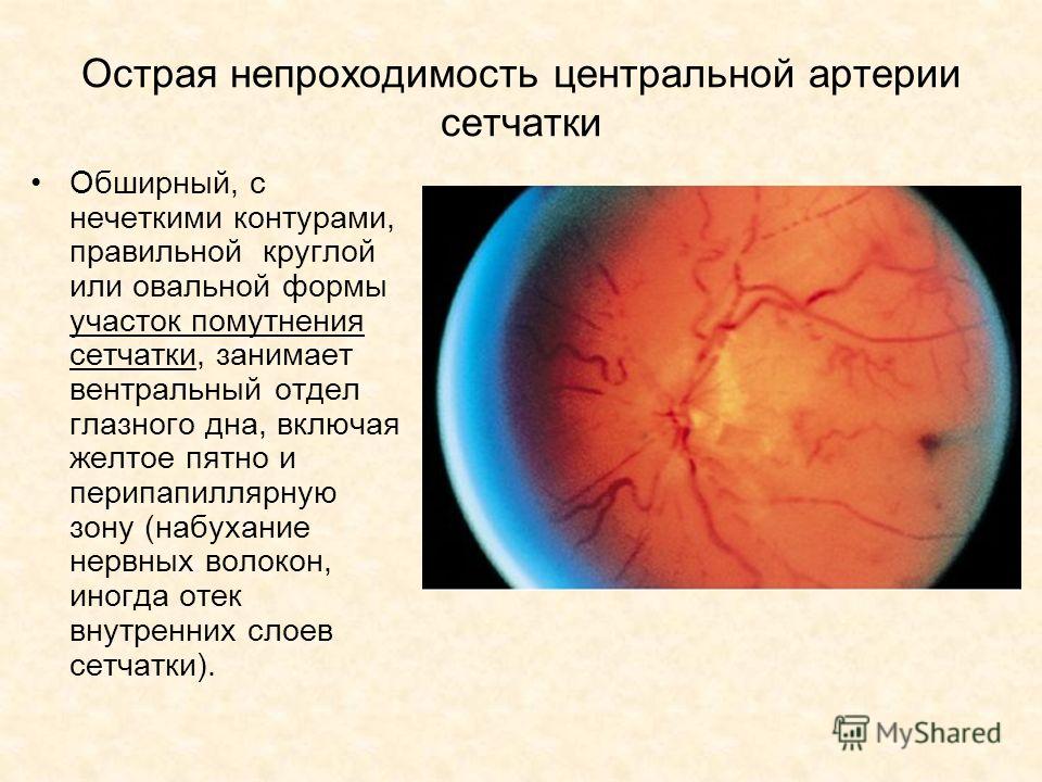 Окклюзия сетчатки глаза. Тромбоз центральной артерии сетчатки клиника. Окклюзия центральной артерии сетчатки офтальмоскопия. Острая непроходимость центральной артерии сетчатки (цас)..