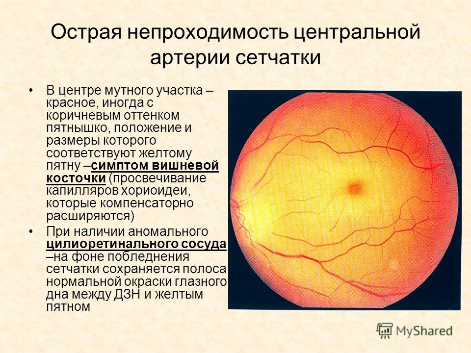 Окклюзия сетчатки глаза. Цас ( Центральная сетчатки. Тромбоз цас глазное дно. Острая непроходимость центральной артерии сетчатки. Проявления острой непроходимости центральной артерии сетчатки.