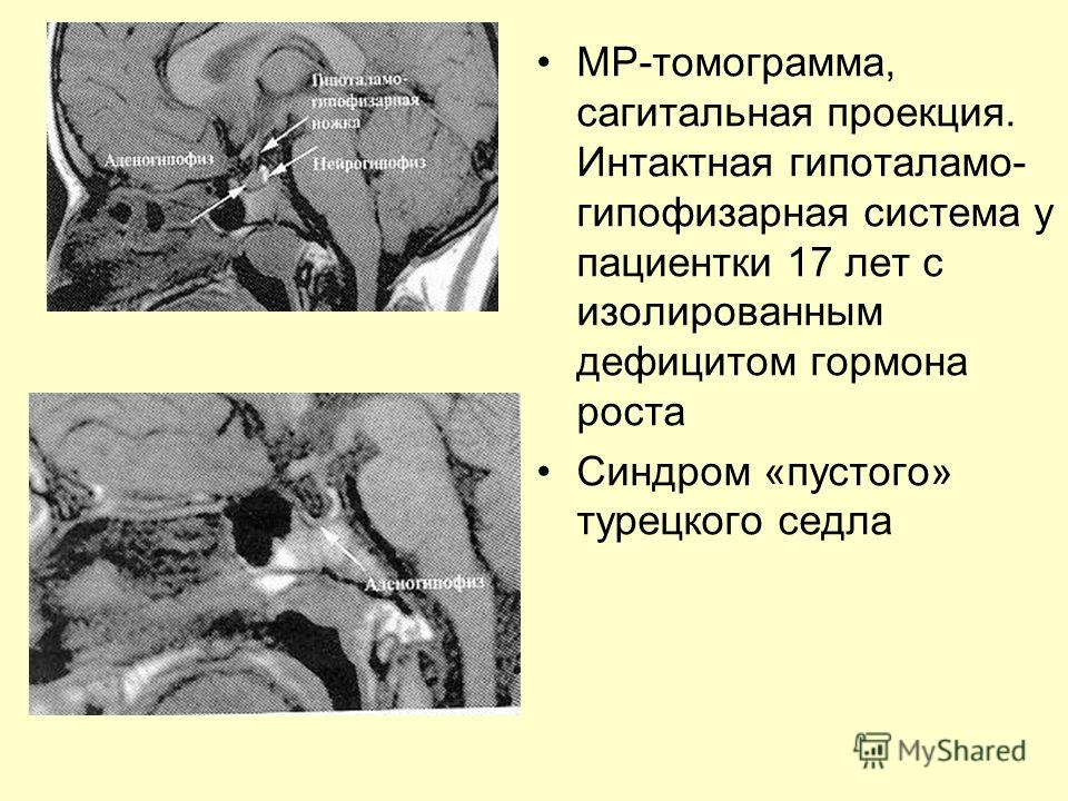 Супраселлярная цистерна пролабирует в полость