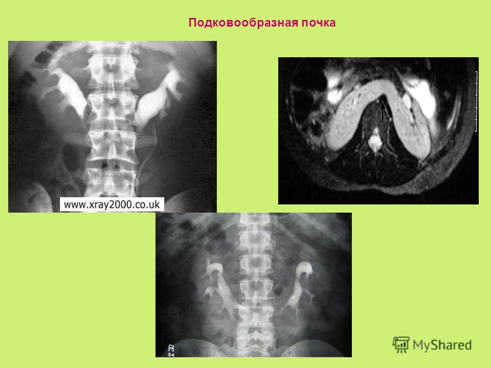 Подковообразная почка на узи фото