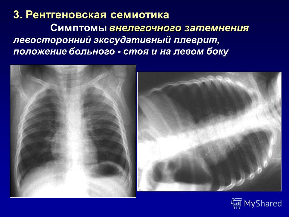 Плеврит по мкб 10 у взрослых