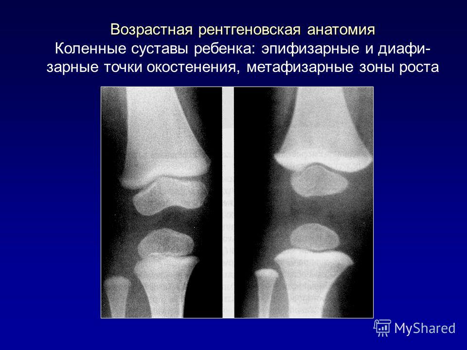 Проекции рентгена коленного сустава