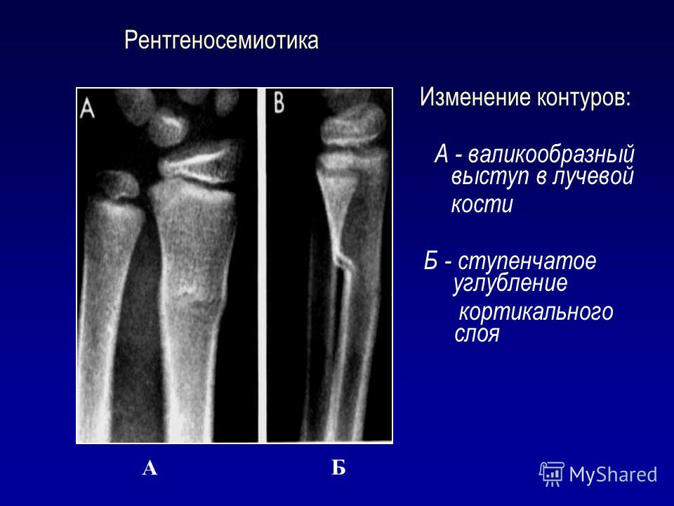 Изменения в костях. Перелом кортикального слоя. Кортикальный слой кости на рентгене. Корковый слой кости на рентгене. Кортикальный слой большеберцовой кости.