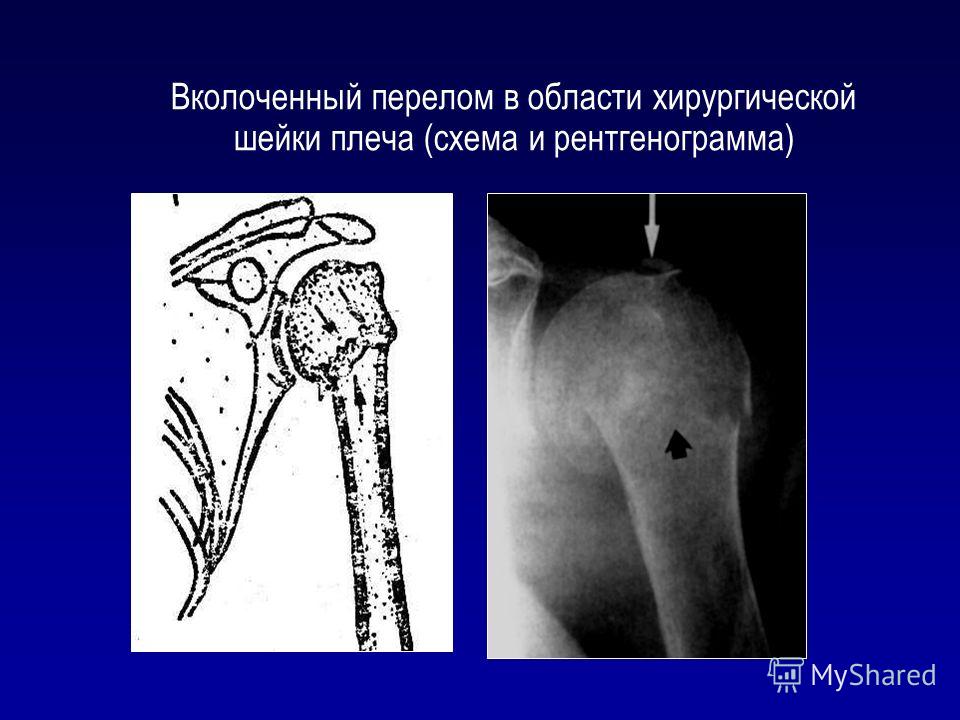 Хирургическая шейка плеча фото