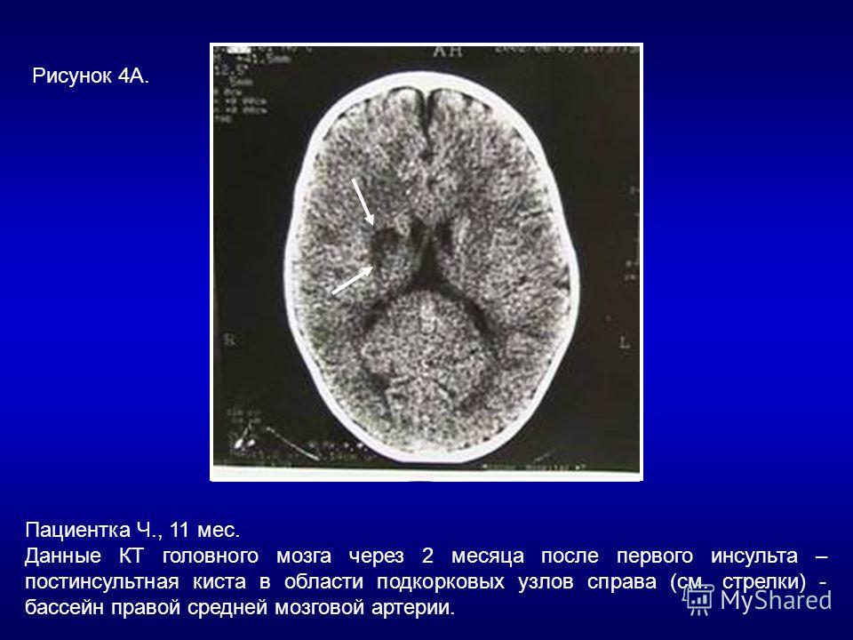 Размеры кист мозга