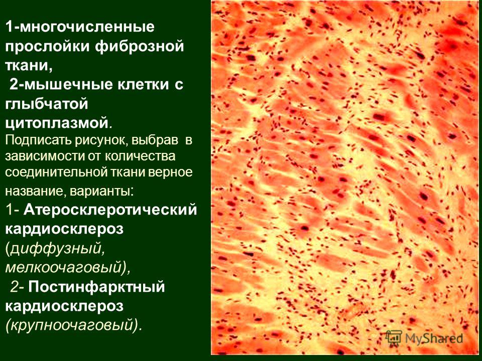 Постинфарктный кардиосклероз что это. Постинфарктный кардиосклероз синдромы. Крупноочаговый и мелкоочаговый постинфарктный кардиосклероз. Постинфарктный кардиосклероз симптомы. Диффузный мелкоочаговый кардиосклероз патогенез.