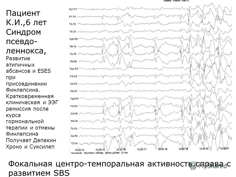 Ээг показывает эпилепсию. Синдром Леннокса-Гасто ЭЭГ. Абсансная эпилепсия на ЭЭГ. Эпилептические паттерны на ЭЭГ. Паттерн абсанса на ЭЭГ.