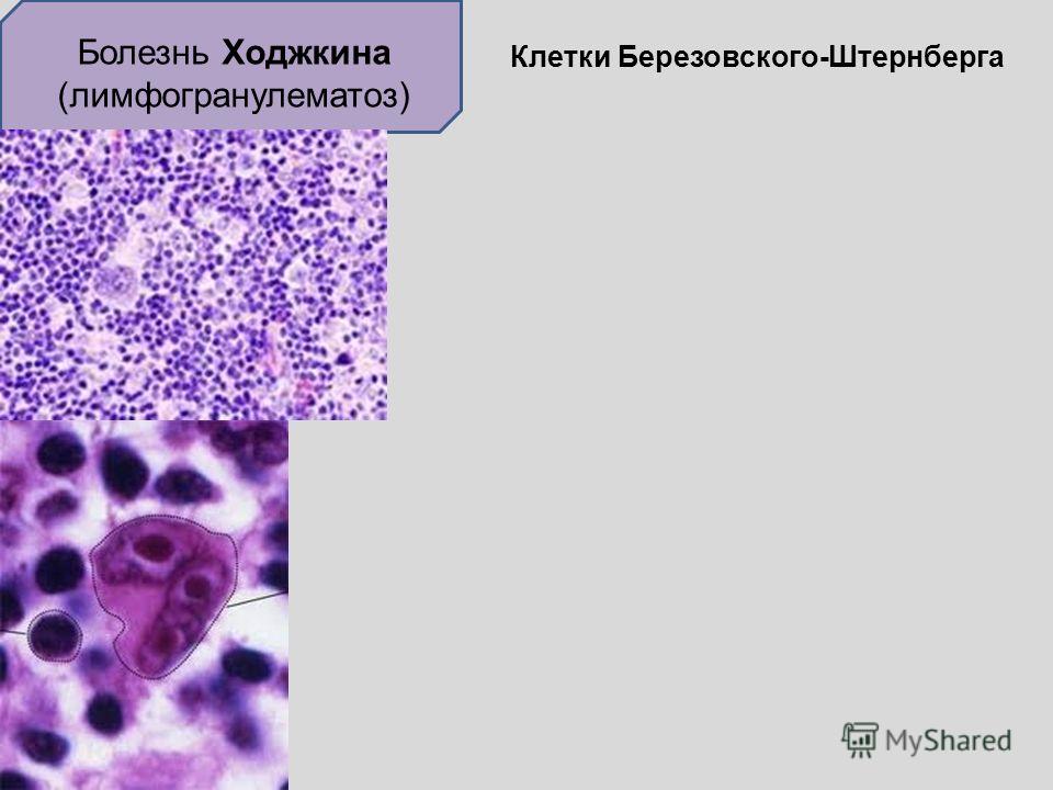 Клетки рида штернберга. Клетки Рид-Березовского-Штернберга. Гигантские многоядерные клетки Рид-Березовского-Штернберга.. Лимфома Ходжкина клетки Березовского-Штернберга-Рид. Лимфогранулематоз гистология клетки Березовского Штернберга.