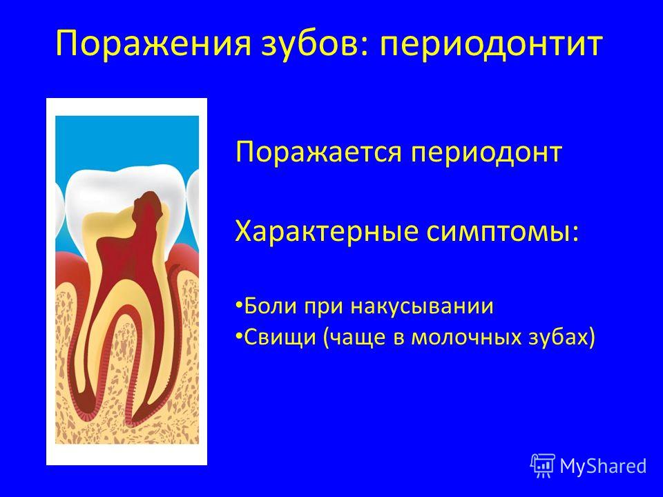 Периодонт. Симптомы пульпит и периодонтит. Пульпит периодонтит зубов классификация. Классификация кариес пульпит периодонтит. Осложнения кариеса пульпиты и периодонтиты.