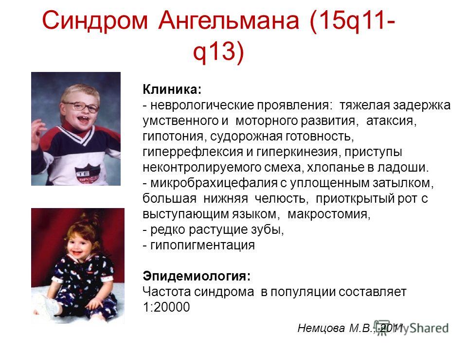 Синдром презентации. Синдром Энгельмана патогенез. Синдром Ангельмана (синдром «счастливой куклы»). Синдром Ангельмана (синдром Энгельмана).