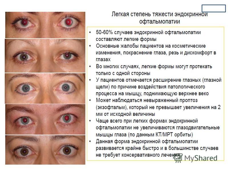 Глазами есть причина по. Эндокринная офтальмопатия. Симптомы офтальмопатии. Эндокринная офтальмопатия глазные симптомы. Симптомы эндокринной офтальмопатии.