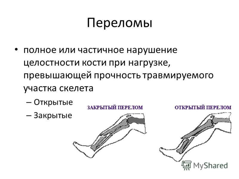 Переломы у взрослых