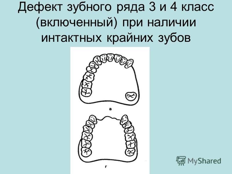 Интактный зуб это. Дефекты зубных рядов. Включенный дефект зубного ряда. 5. Дефекты зубных рядов. Клиновидный дефект стоматологическая карта.