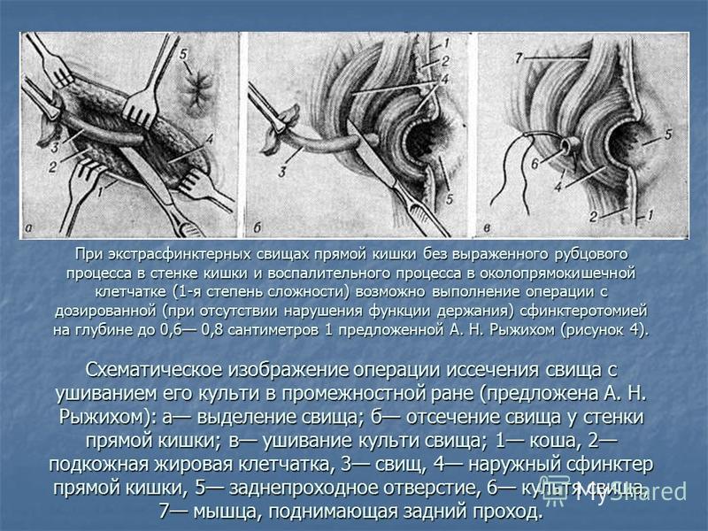 Презентация операции на прямой кишке