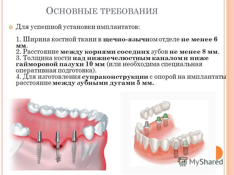 Можно ставить импланты при диабете. Ширина импланта зуба. Расстояние между имплантом и зубом. Расстояние между имплантами зубов. Антибиотики после имплантации.