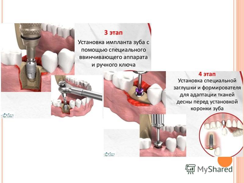 Пошагово как ставить импланты. Этапы имплантации зубов. Этапы зубной имплантации. Этапы установки импланта зуба. Схема установки импланта зуба.
