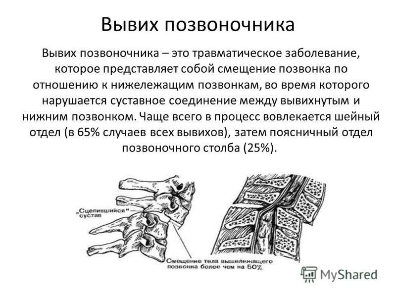 Смещение шейных позвонков у ребенка