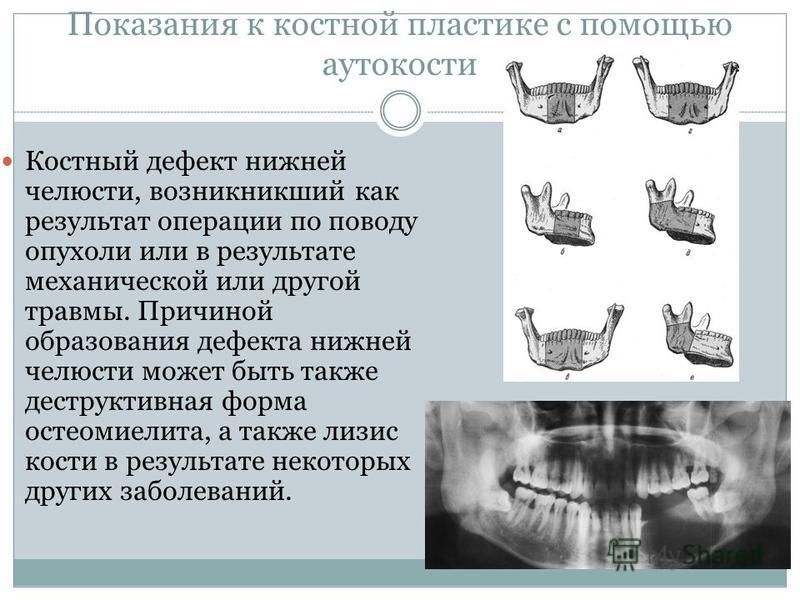 Костная пластика презентация