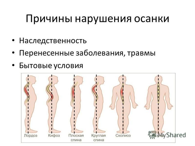 Причины нарушения осанки